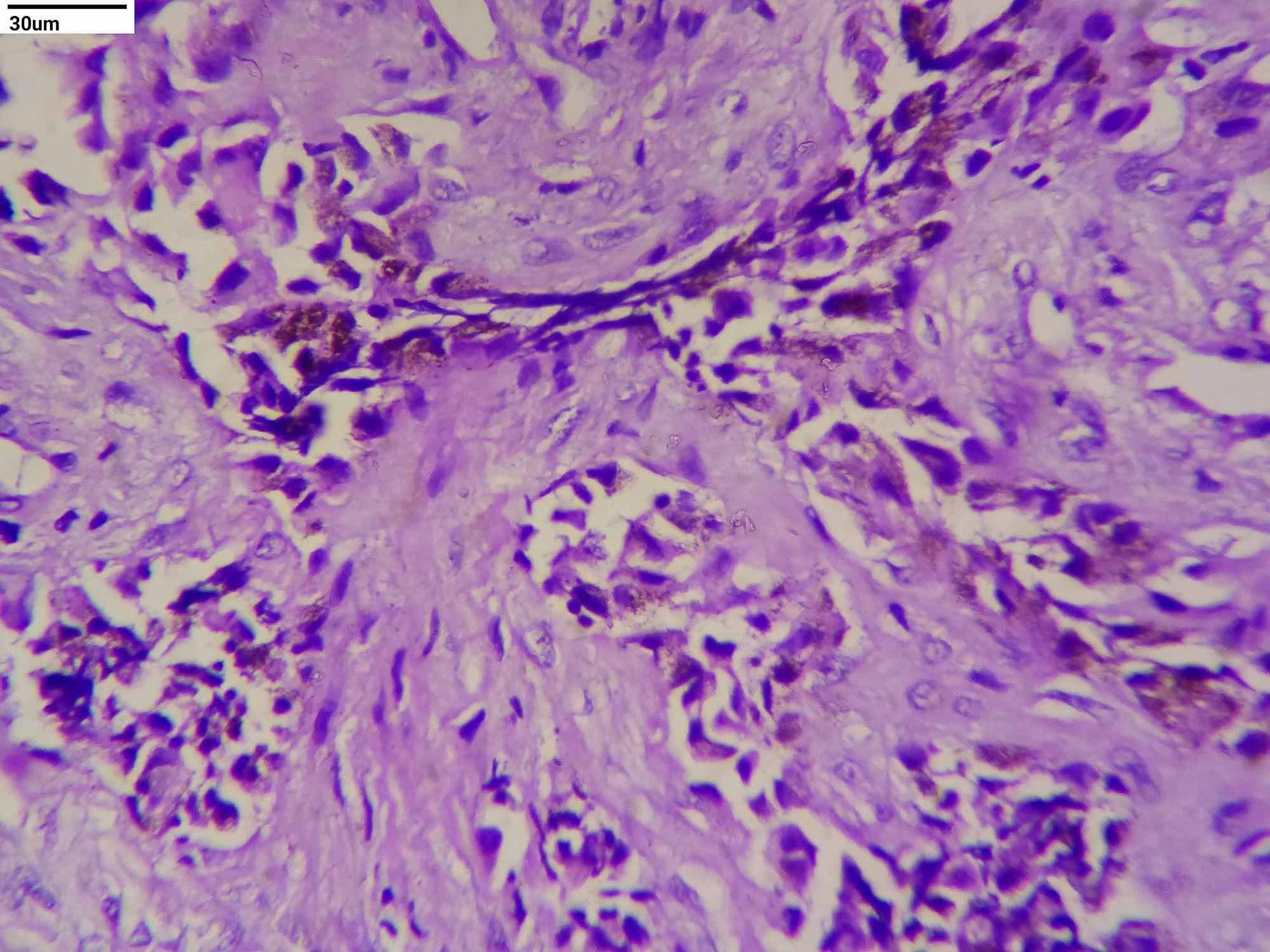 melanotic neuroectodermal tumor of infancy