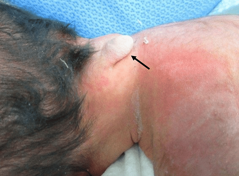 キアリIII奇形における水頭症管理のための新生児心室リザーバー移植：症例報告