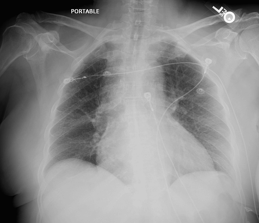peri-myocarditis-as-a-dire-consequence-of-coronavirus-disease-a