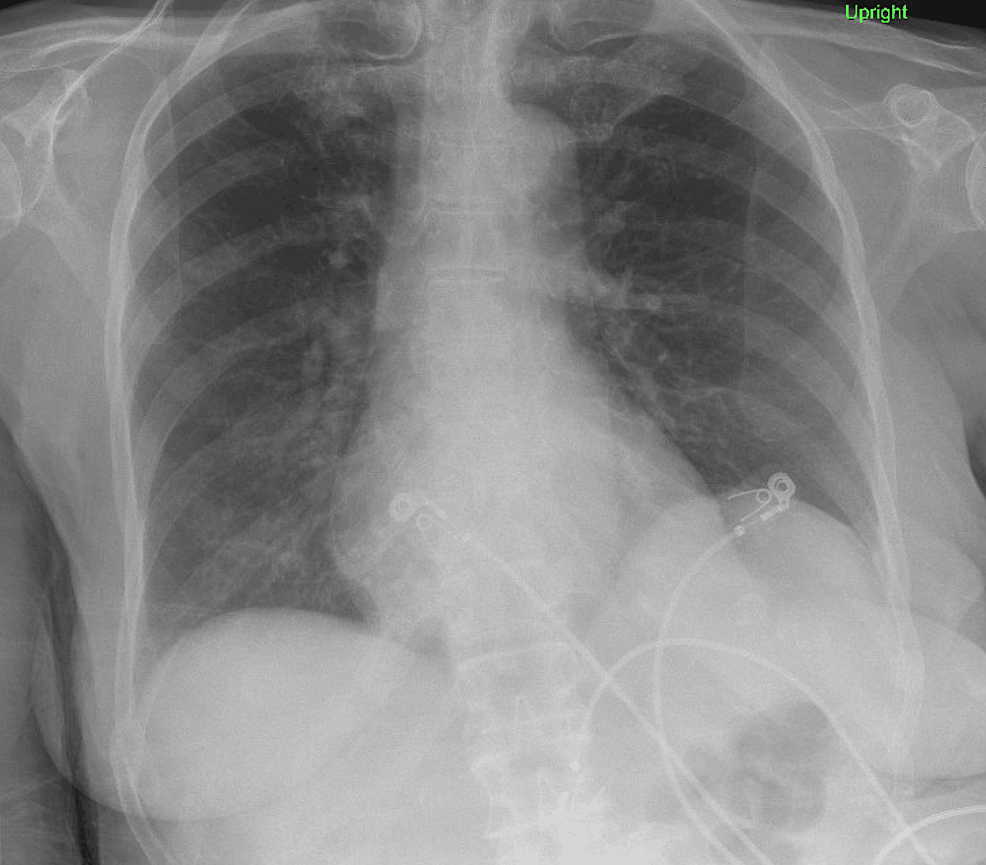 Daptomycin-Induced Eosinophilic Pneumonia: Can an Antibiotic Cause ...