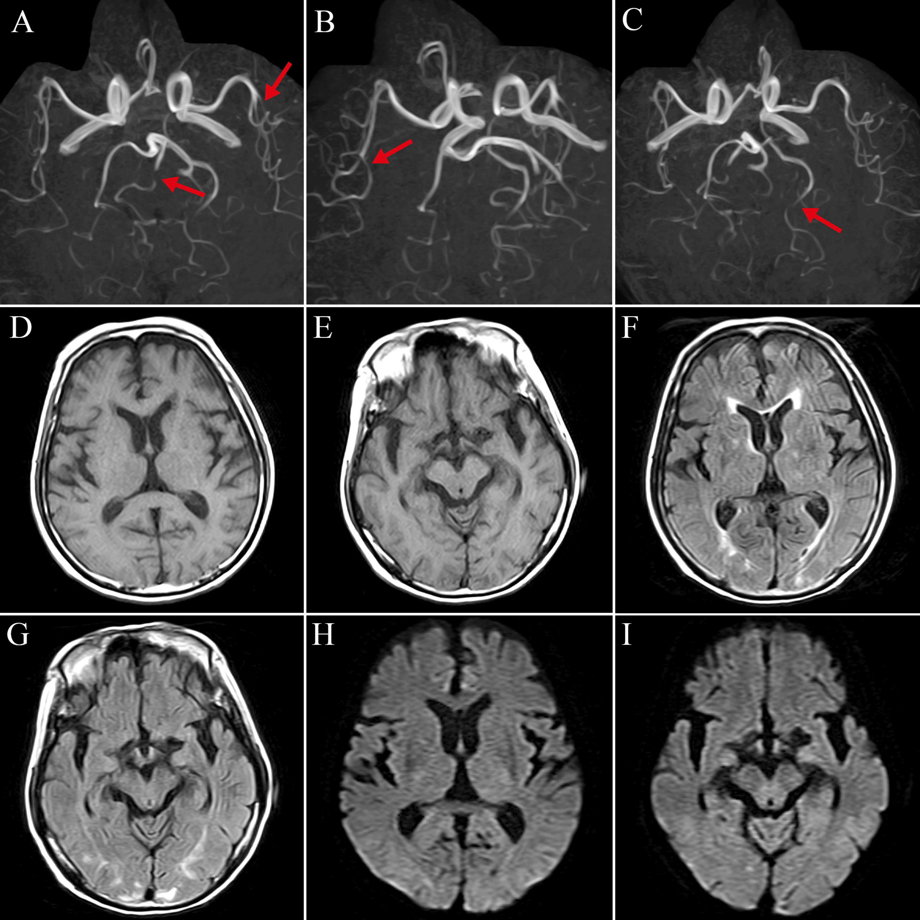 An Autopsy Case of Reversible Cerebral Vasoconstriction Syndrome After ...