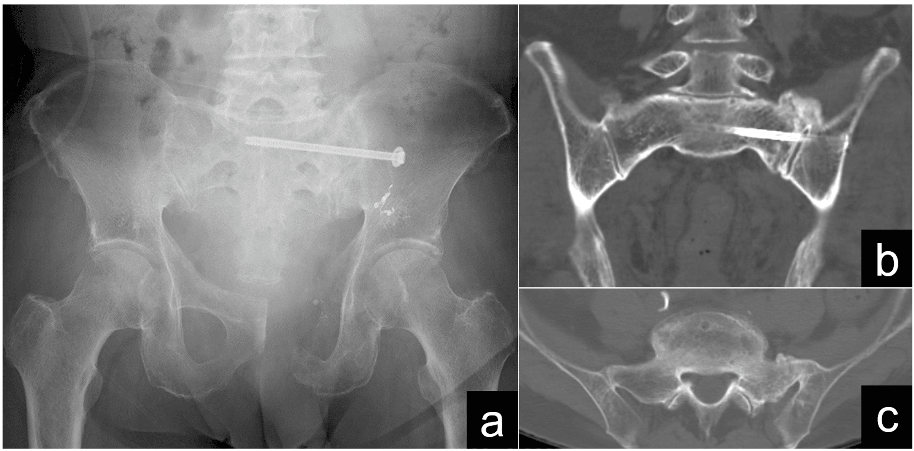 Effective Management Of Sacral Stress Fractures In Gastric Cancer ...