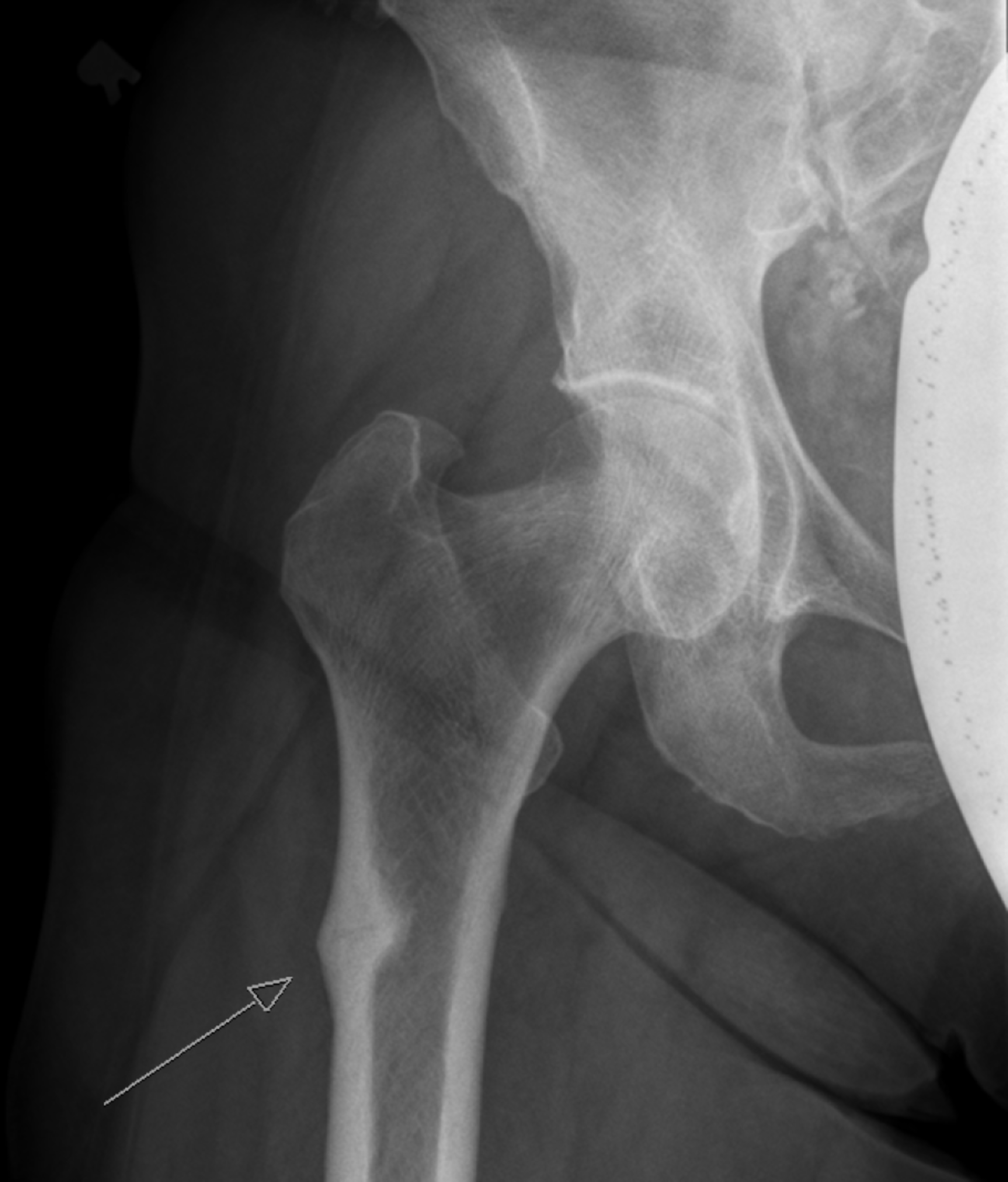 Cureus | Paradoxical Stress Fracture in a Patient With Multiple Myeloma ...