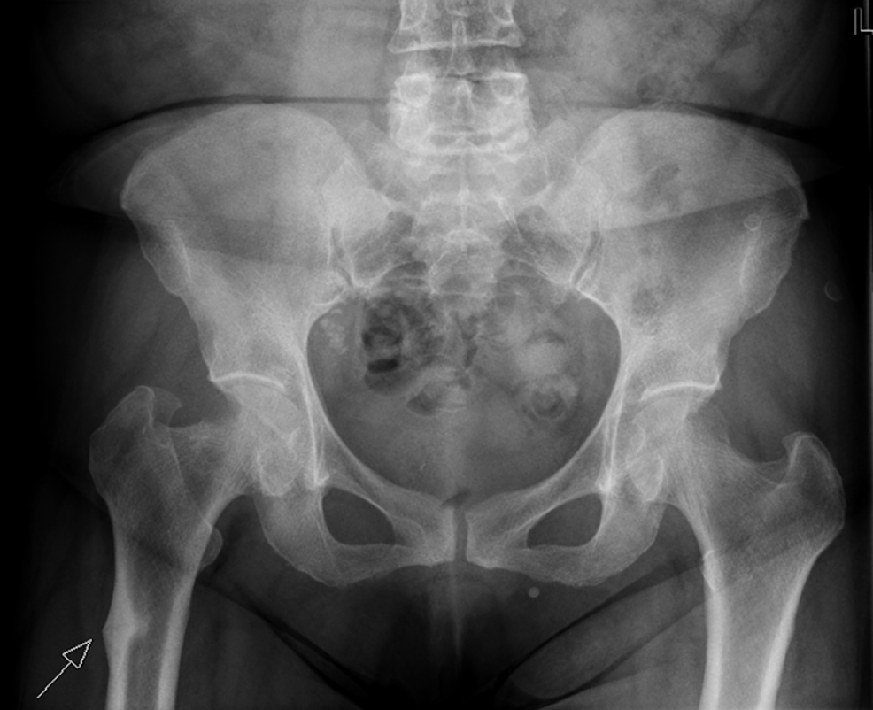 Cureus | Paradoxical Stress Fracture in a Patient With Multiple Myeloma ...