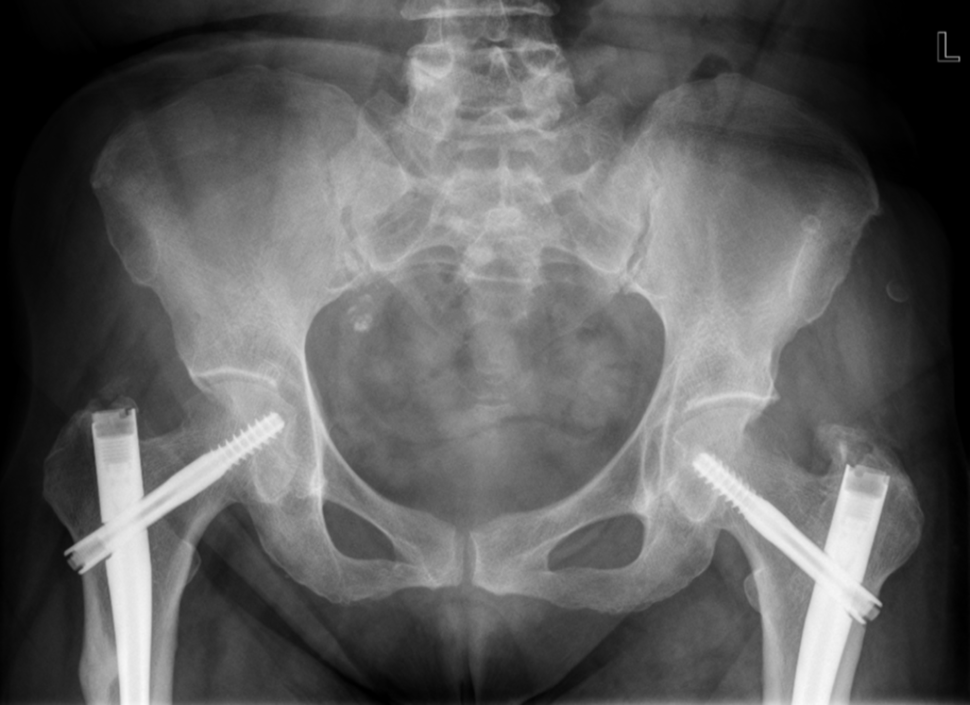 Cureus | Paradoxical Stress Fracture in a Patient With Multiple Myeloma ...