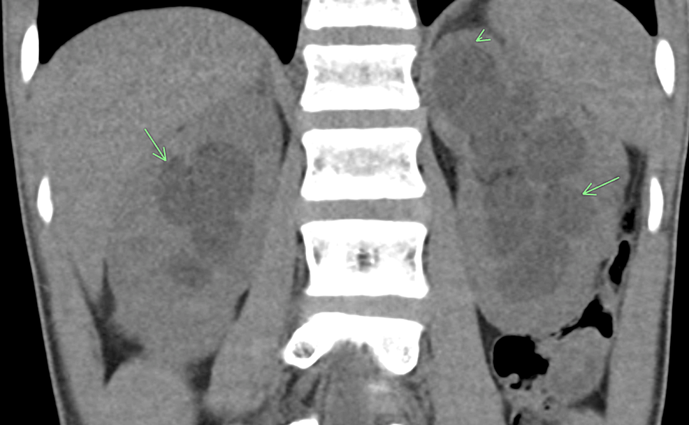 Hinman Syndrome: A Rare Entity With Neurogenic Bladder-like Symptoms 