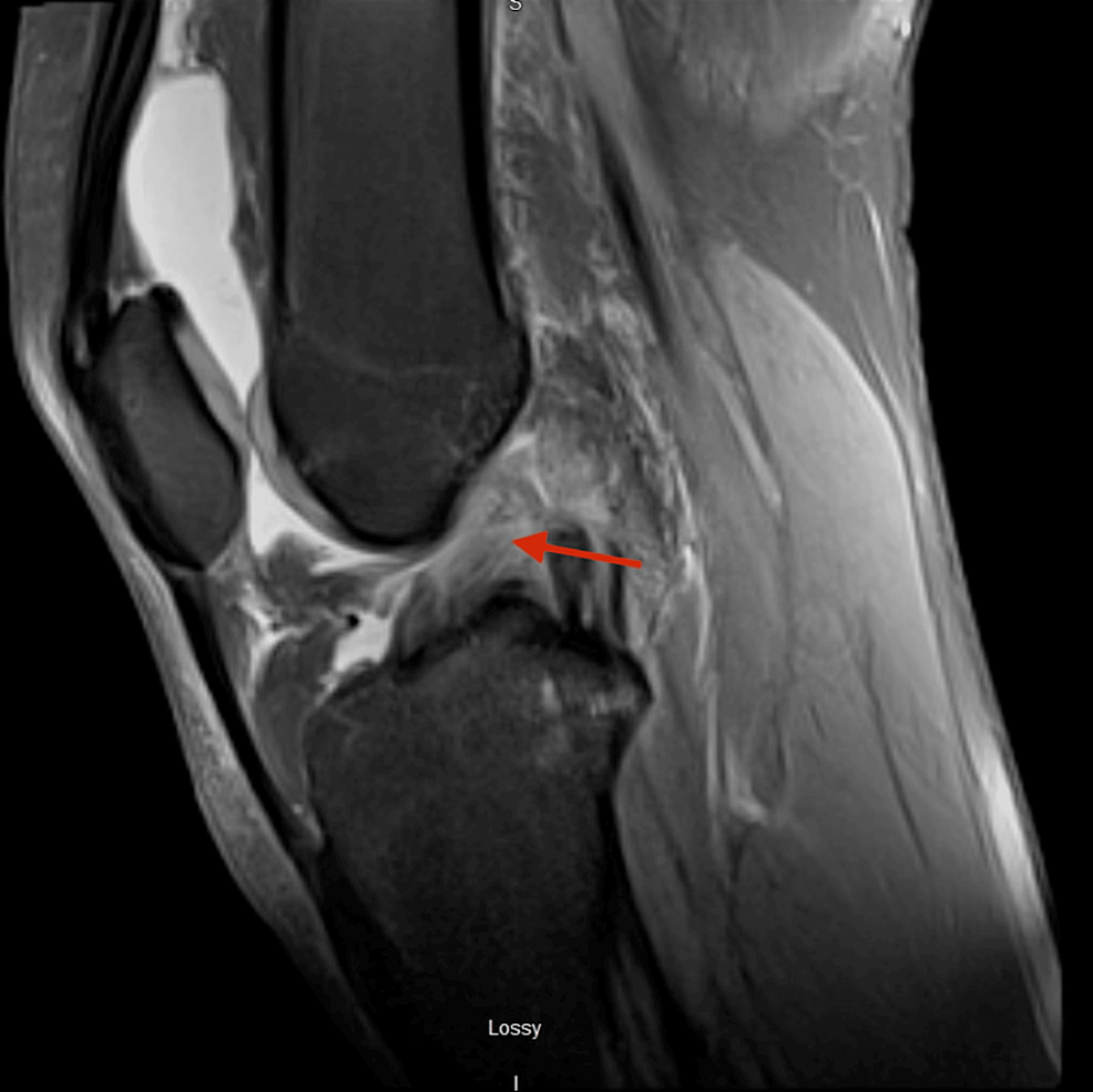 Hamstring Anterior Cruciate Ligament Autograft Contributes to a Delayed ...