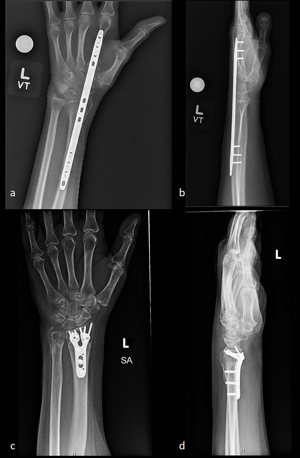 Cureus Distal Radius Fracture Therapy Utilization Following Traditional Open Reduction and
