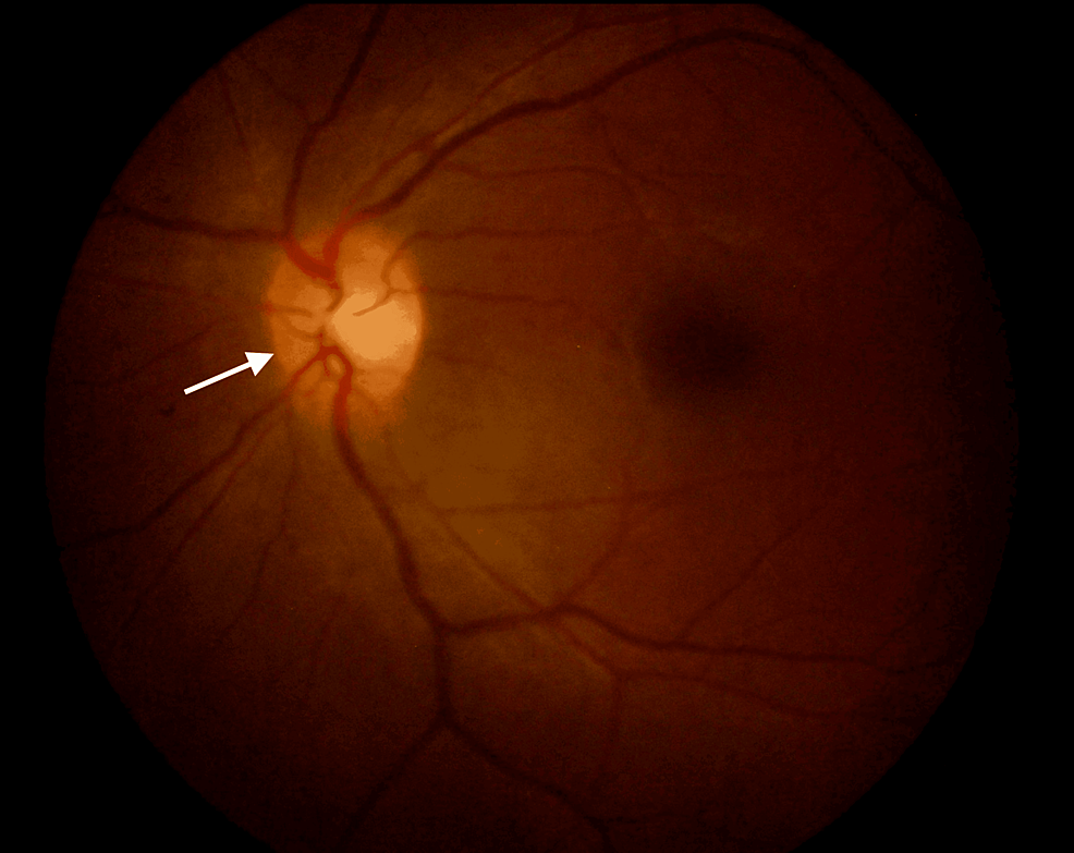 concurrent-tuberculous-optic-neuritis-and-optic-perineuritis-in-a