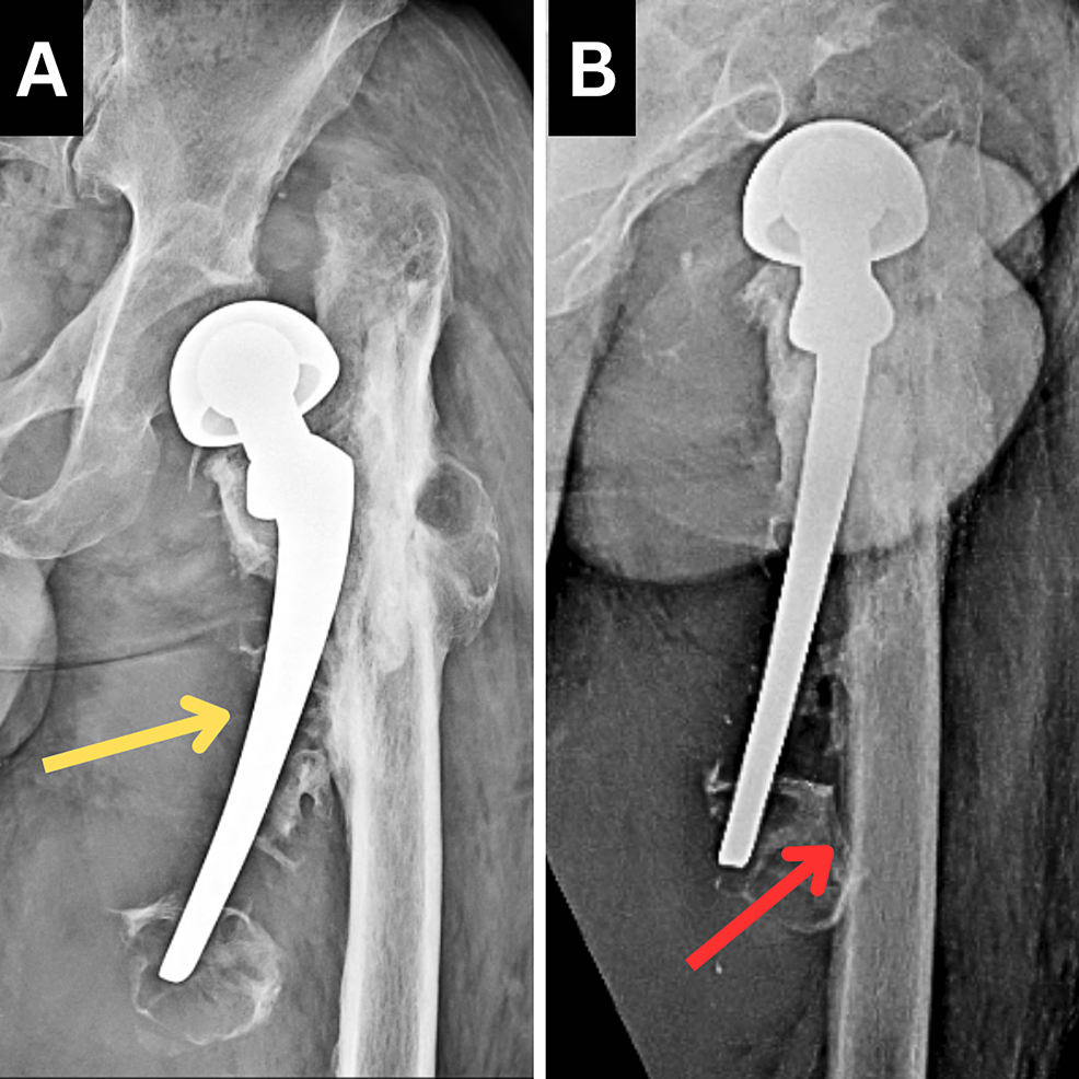 Frontiers | Augmentation of intramedullary nail in unstable  intertrochanteric fractures with plate or cable