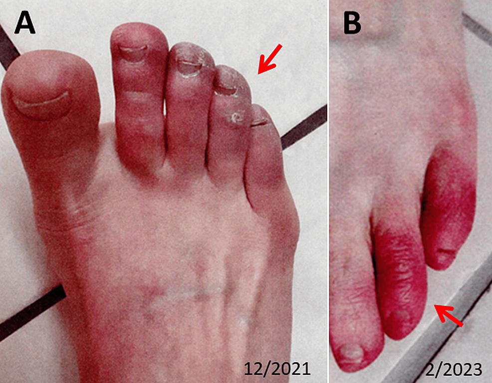 Cureus, Myocarditis, Coagulopathy, and Small Fibre, Sensory, and Multiple  Cranial Nerve Neuropathy Complicating BNT162b2 Vaccination: A Case Report