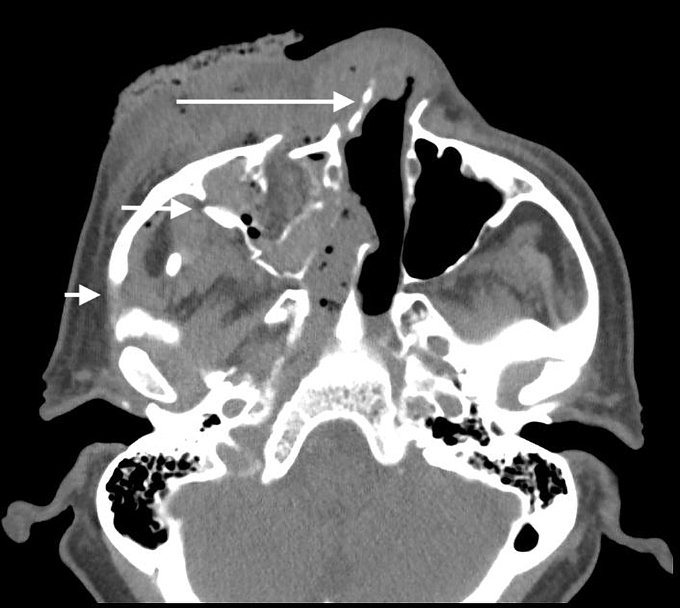 Cureus | Endovascular Management of Uncontrollable Orbital Hemorrhage ...