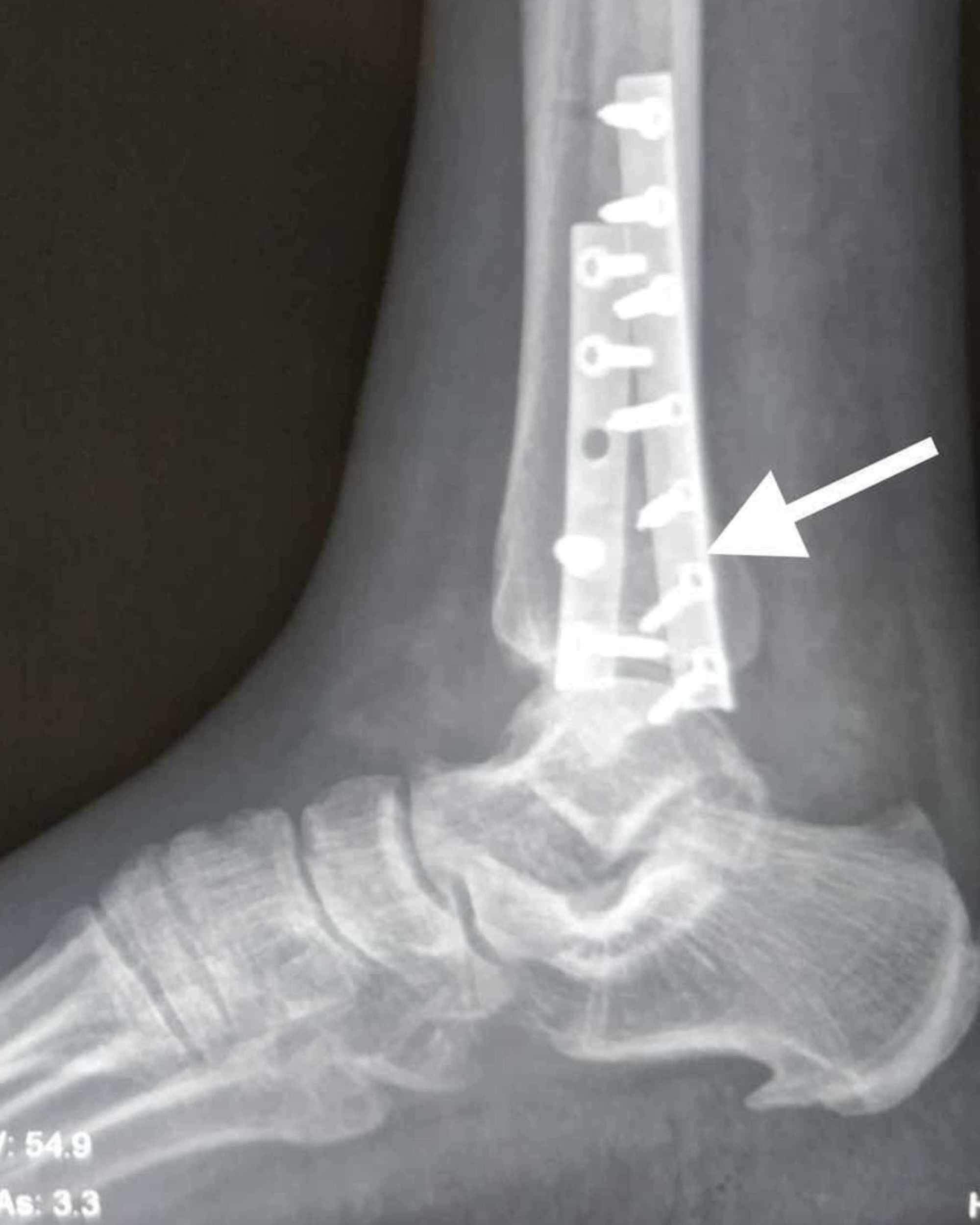 does distal fibula fracture need surgery