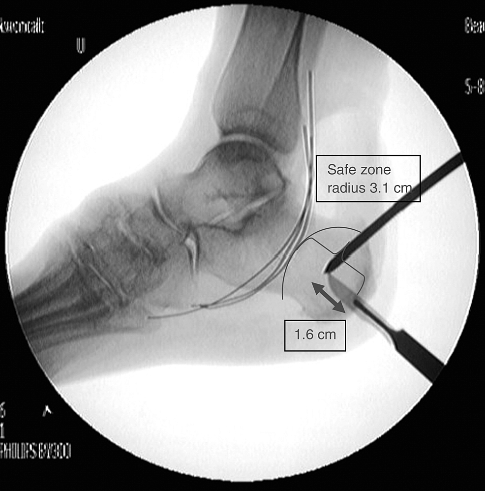 Cureus Addition of a Second Calcaneal Pin for Spanning Ankle External