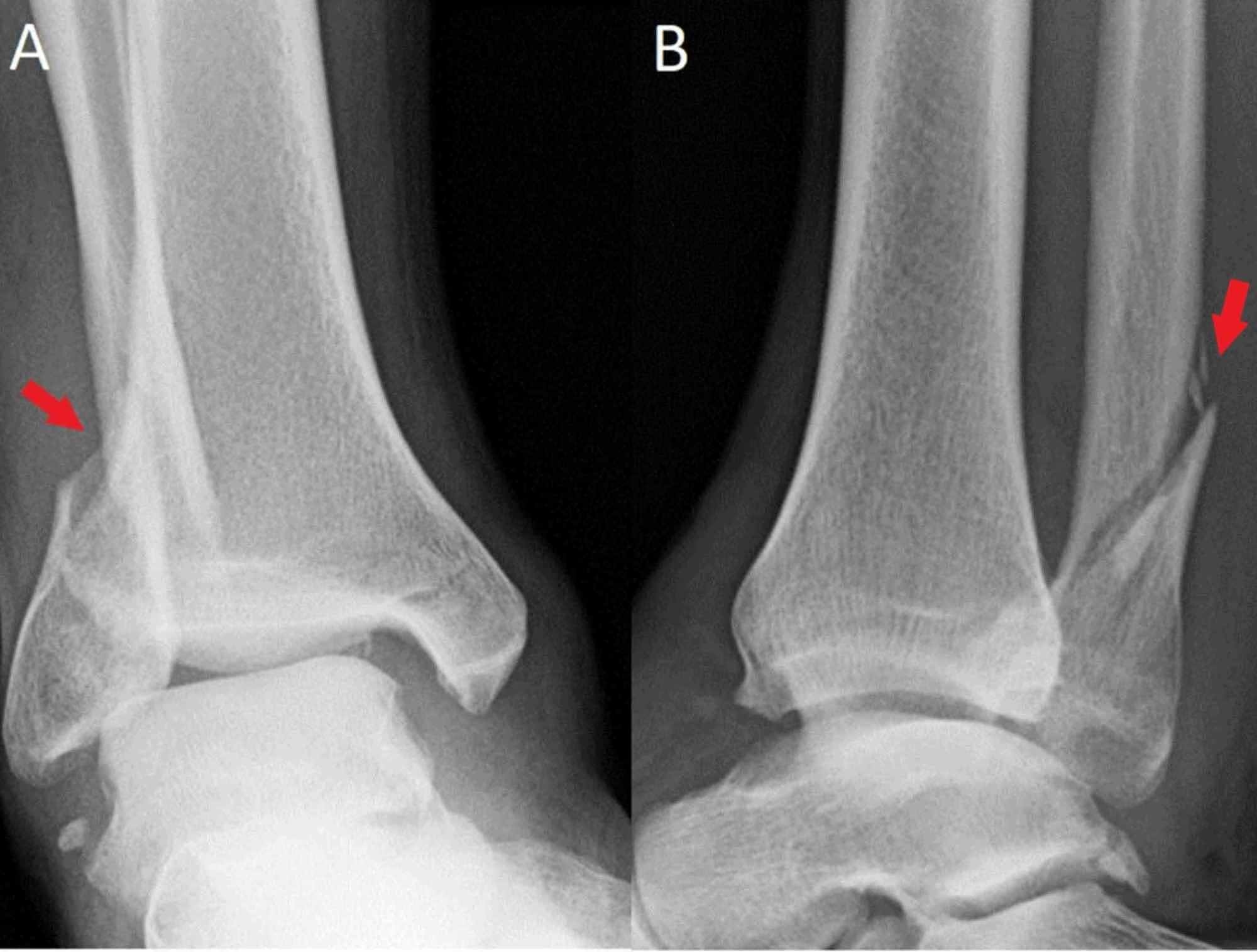 a patient underwent closed reduction of a closed fracture