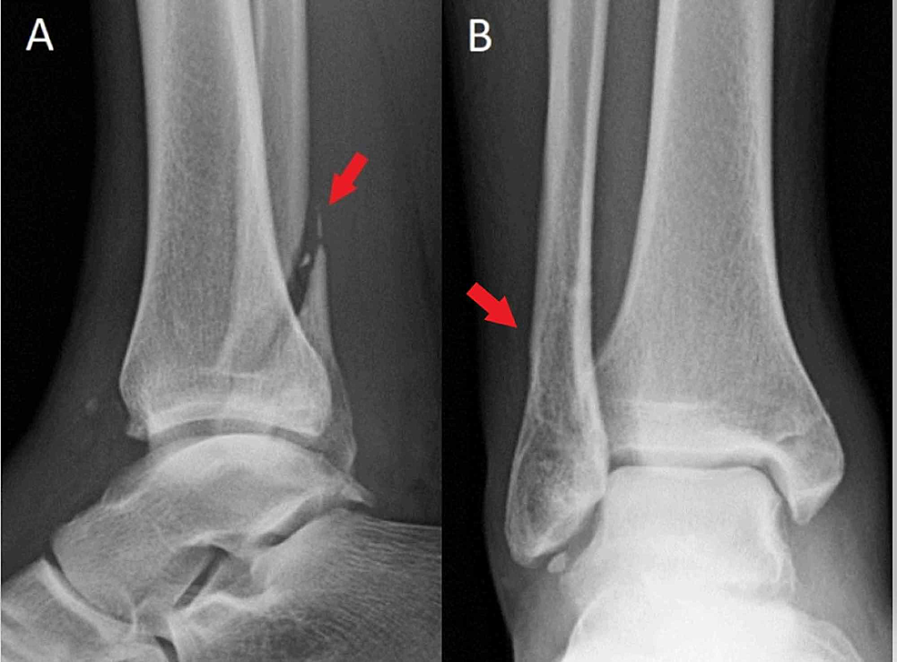 a patient underwent closed reduction of a closed fracture