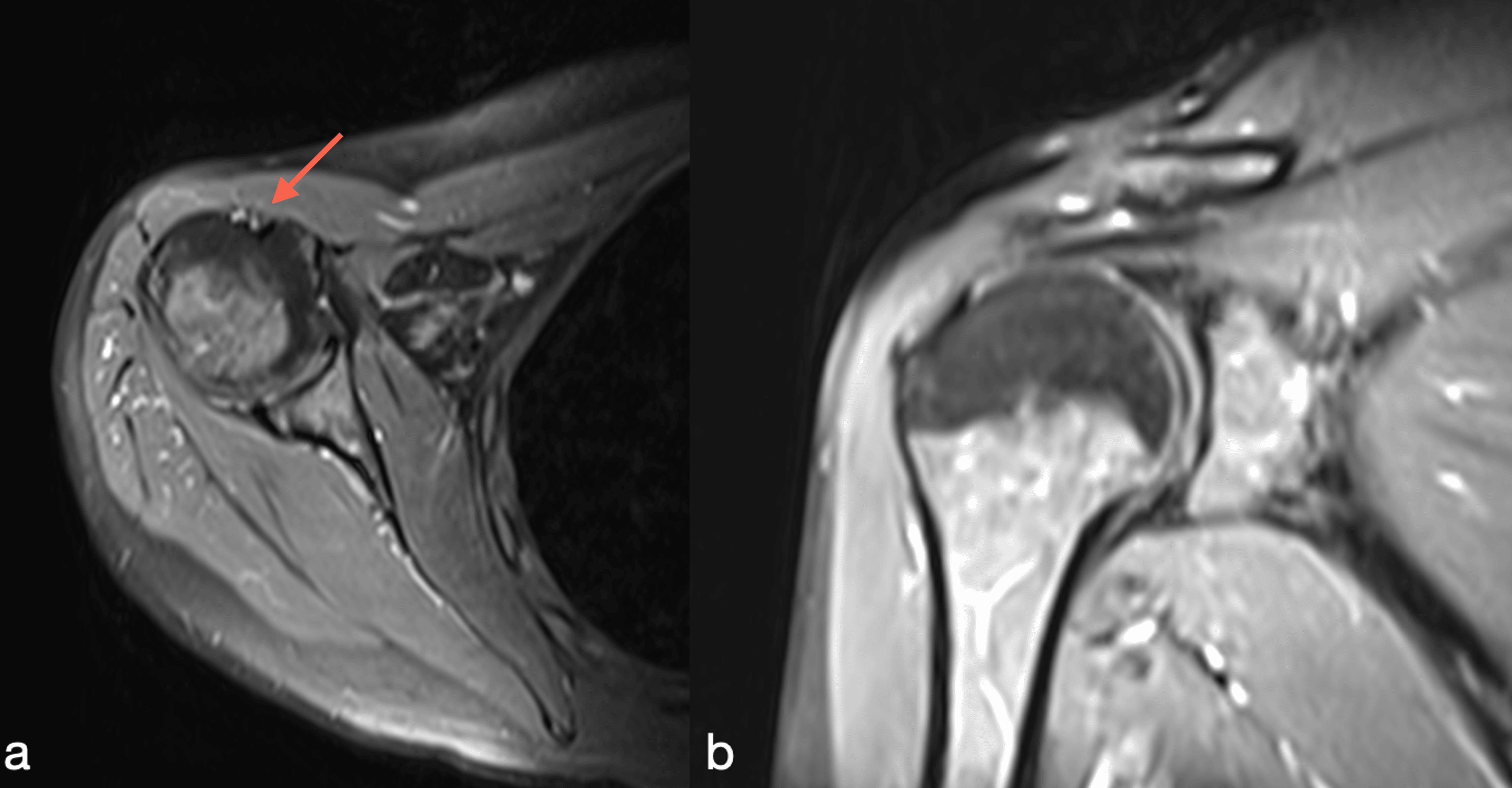 Cureus | Arthroscopic Suprapectoral Biceps Tenodesis For Isolated ...