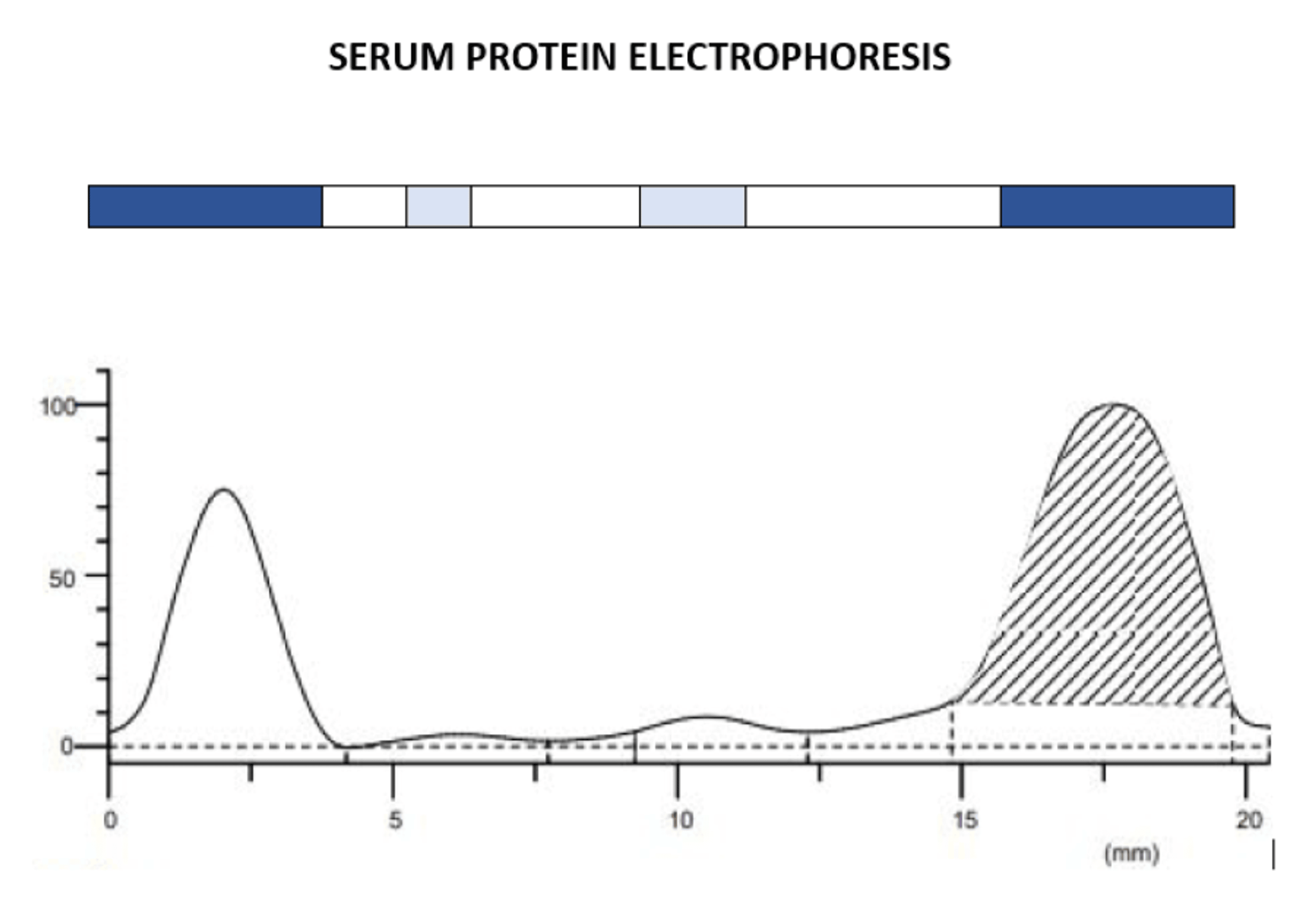 Multiple Myeloma Presenting With Bronchopneumonia A Case Report Cureus