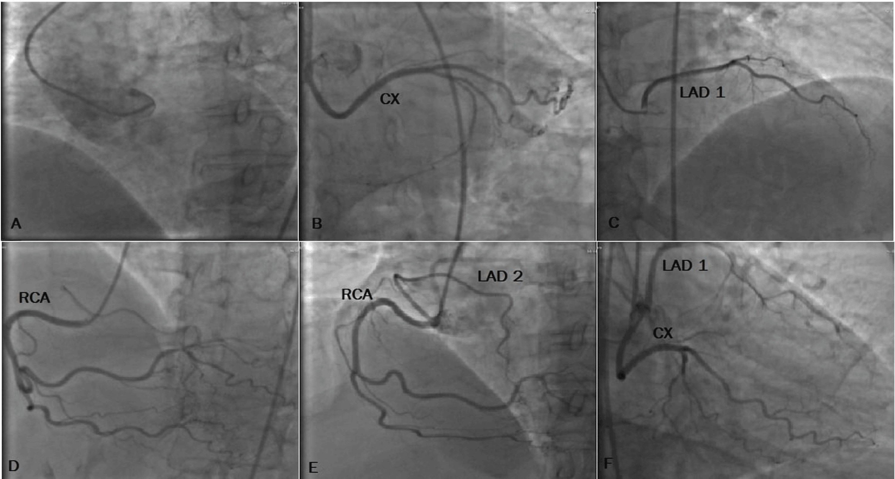 Aortic Origin Coronary Artery Anomalies: A Case Series | Cureus