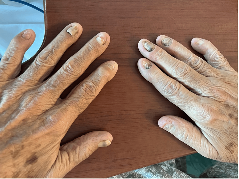 Yellow Nail Syndrome: A Rare Cause of Pleural Effusion | Archivos de  Bronconeumología