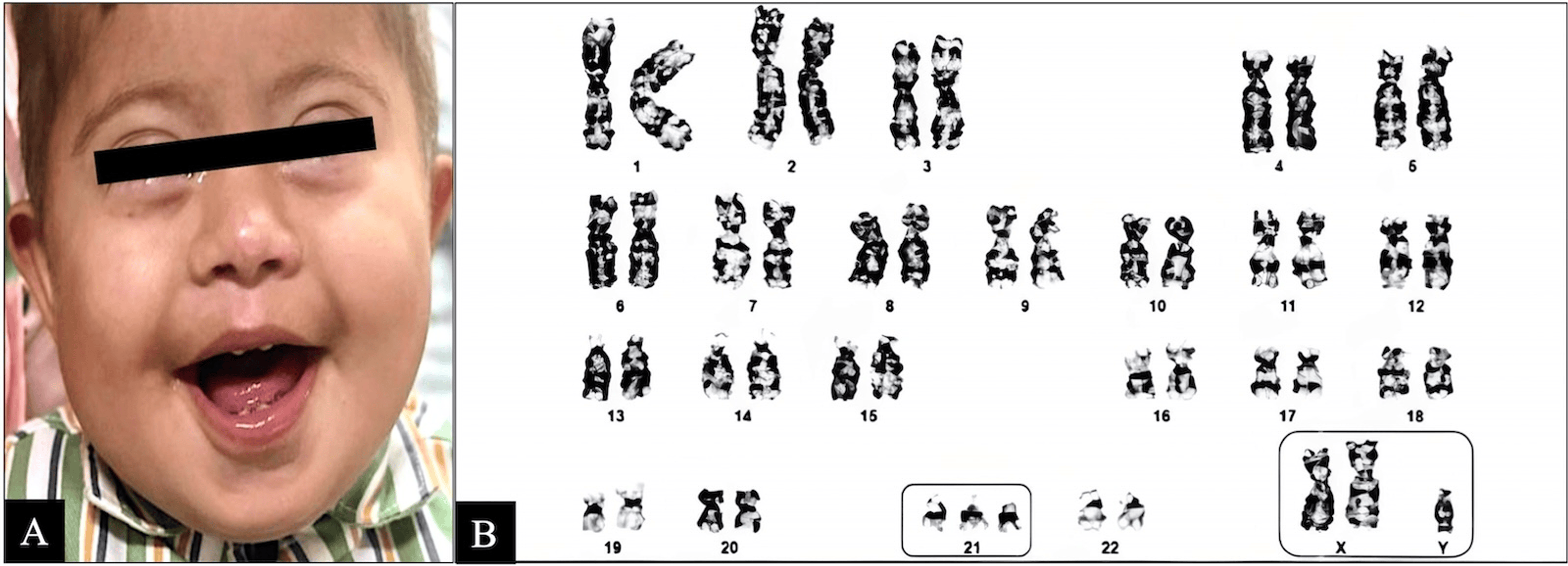 DownKlinefelter Syndrome With Concurrent Double Aneuploidy in an