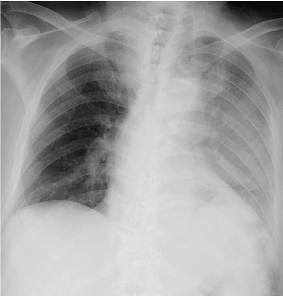 cureus-infectious-pulmonary-artery-pseudoaneurysm-secondary-to-a-lung