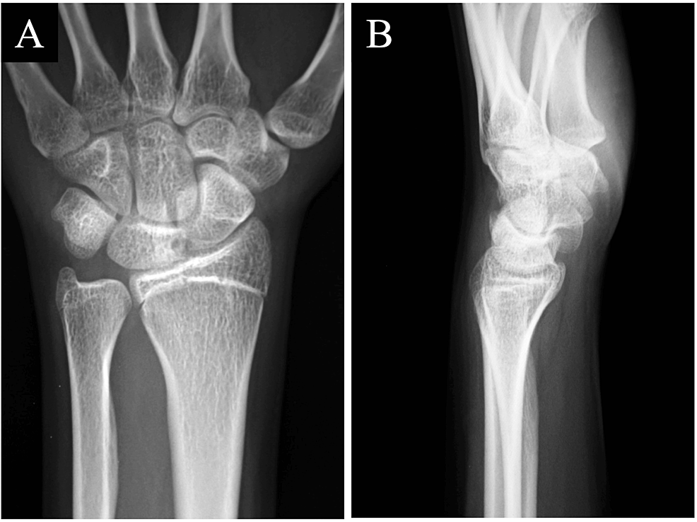 Cureus | Intraosseous Ganglion Spanning the Scaphoid and Lunate: A Case ...
