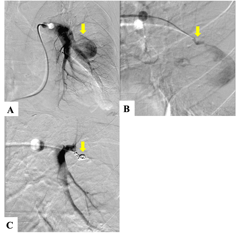 Infectious Pulmonary Artery Pseudoaneurysm Secondary to a Lung Abscess