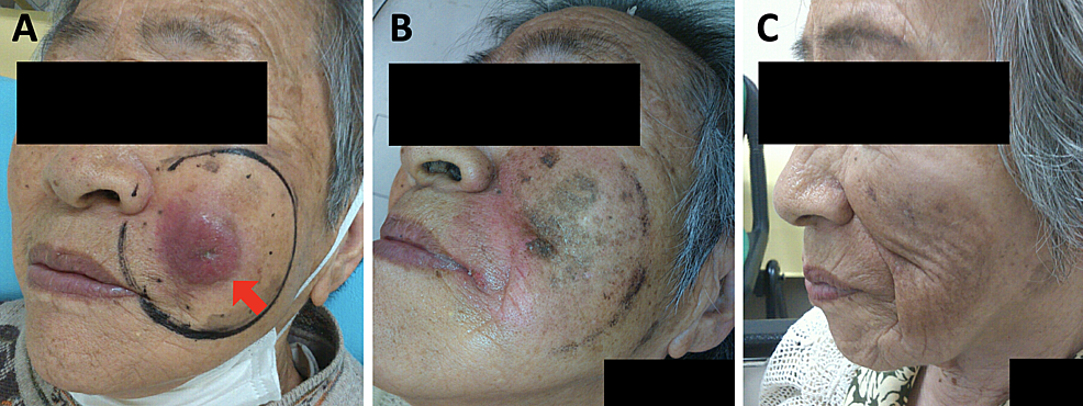 Cureus | Mild Hypofractionated Radiation Therapy for ...