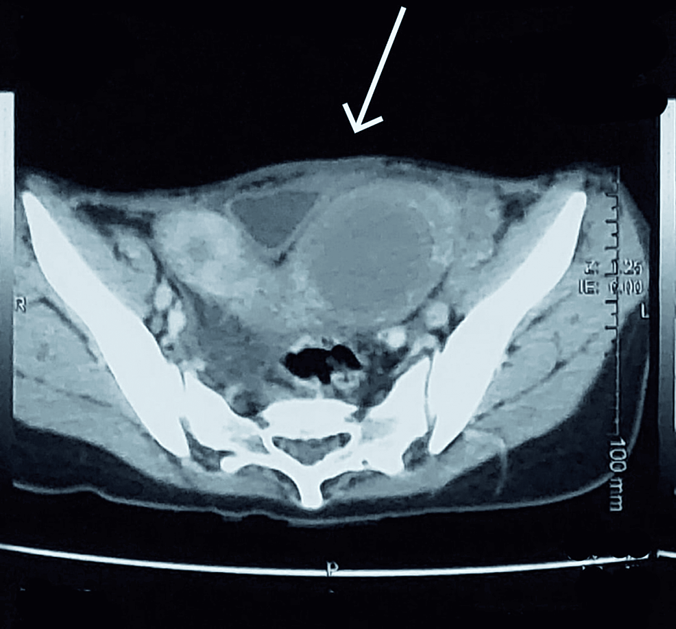 Cureus, A Case of Hemorrhagic Ovarian Cyst Rupture Necessitating Surgical  Intervention