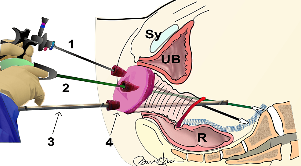 Cureus  Combined Laparoscopic Open Surgical Approach for De