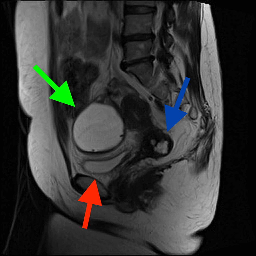 Nabothian Cyst Mri