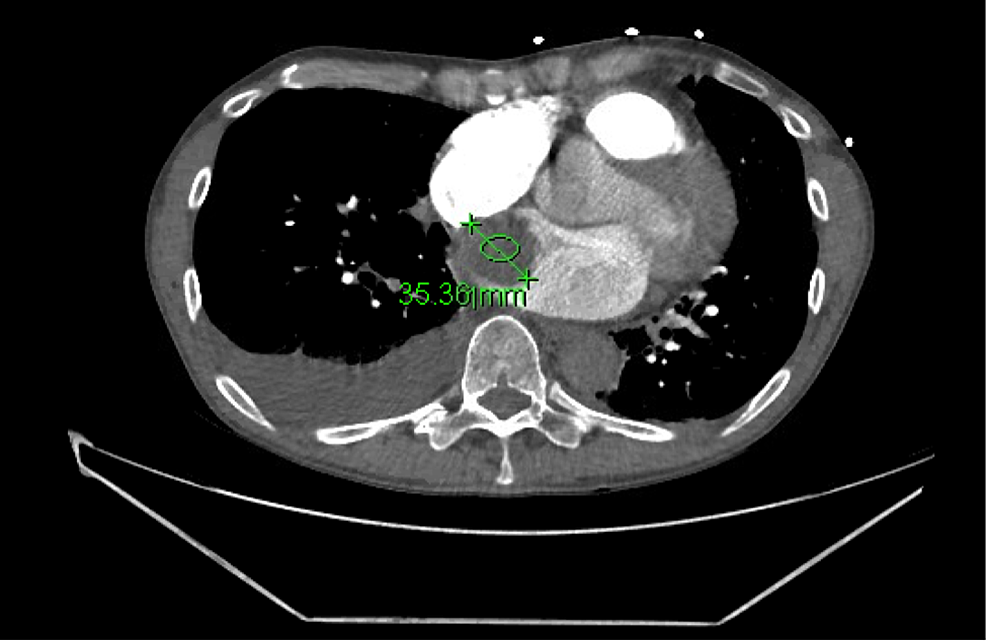 CT-scan-to-rule-out-pulmonary-embolism-showing-a-35.36-mm-right-atrial-cardiac-tumor.