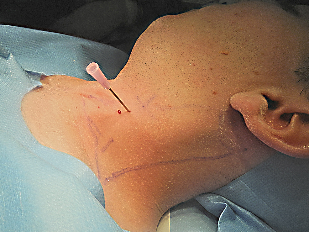 Intraoperative-view-showing-an-18-G-needle-used-to-perform-myotomies