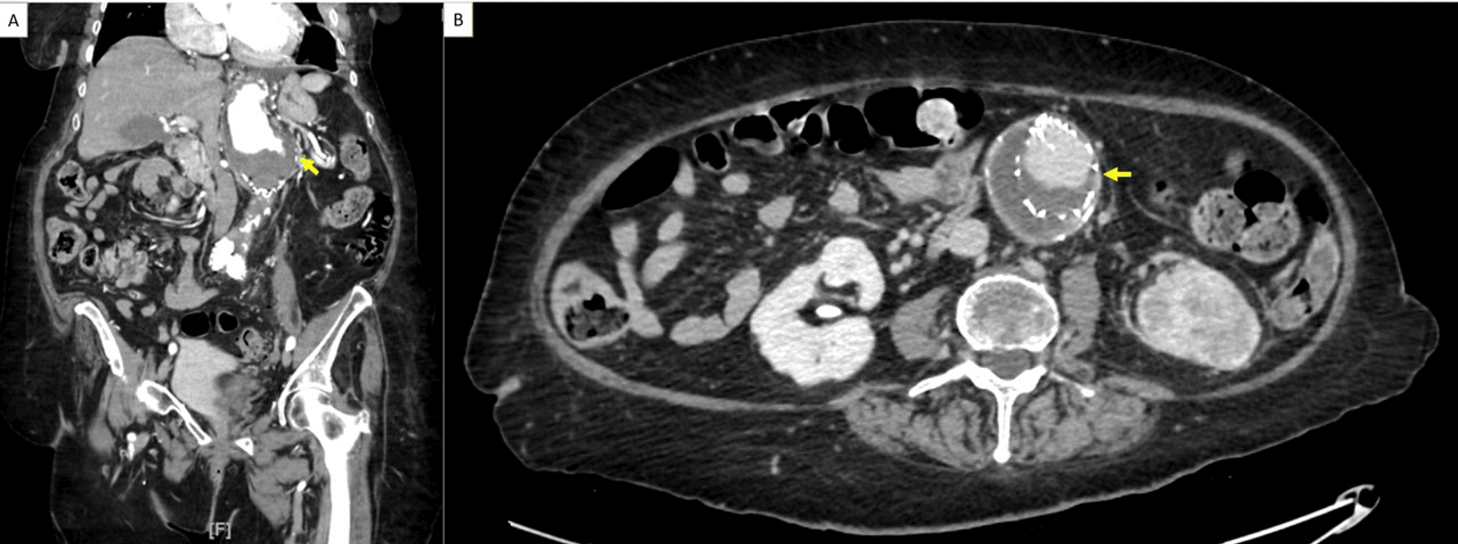 Left Renal Artery Chronic Occlusion in the Setting of Extensive