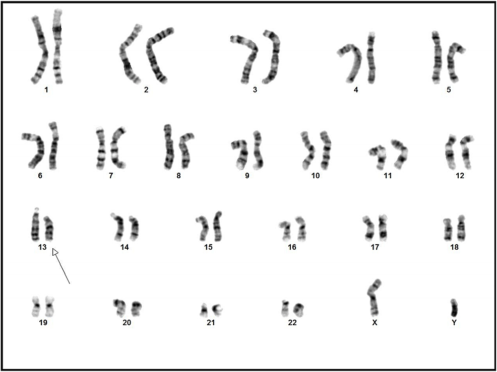 Chromosomal-analysis-revealing-46XY-karyotype-with-13q-deletion