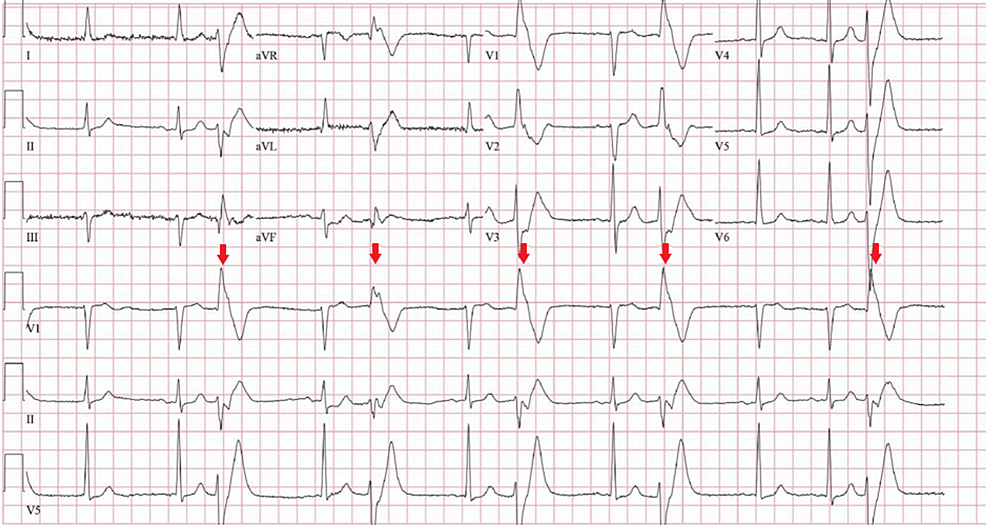 Cureus | Idioventricular Rhythm: A Rare Presentation of Left ...