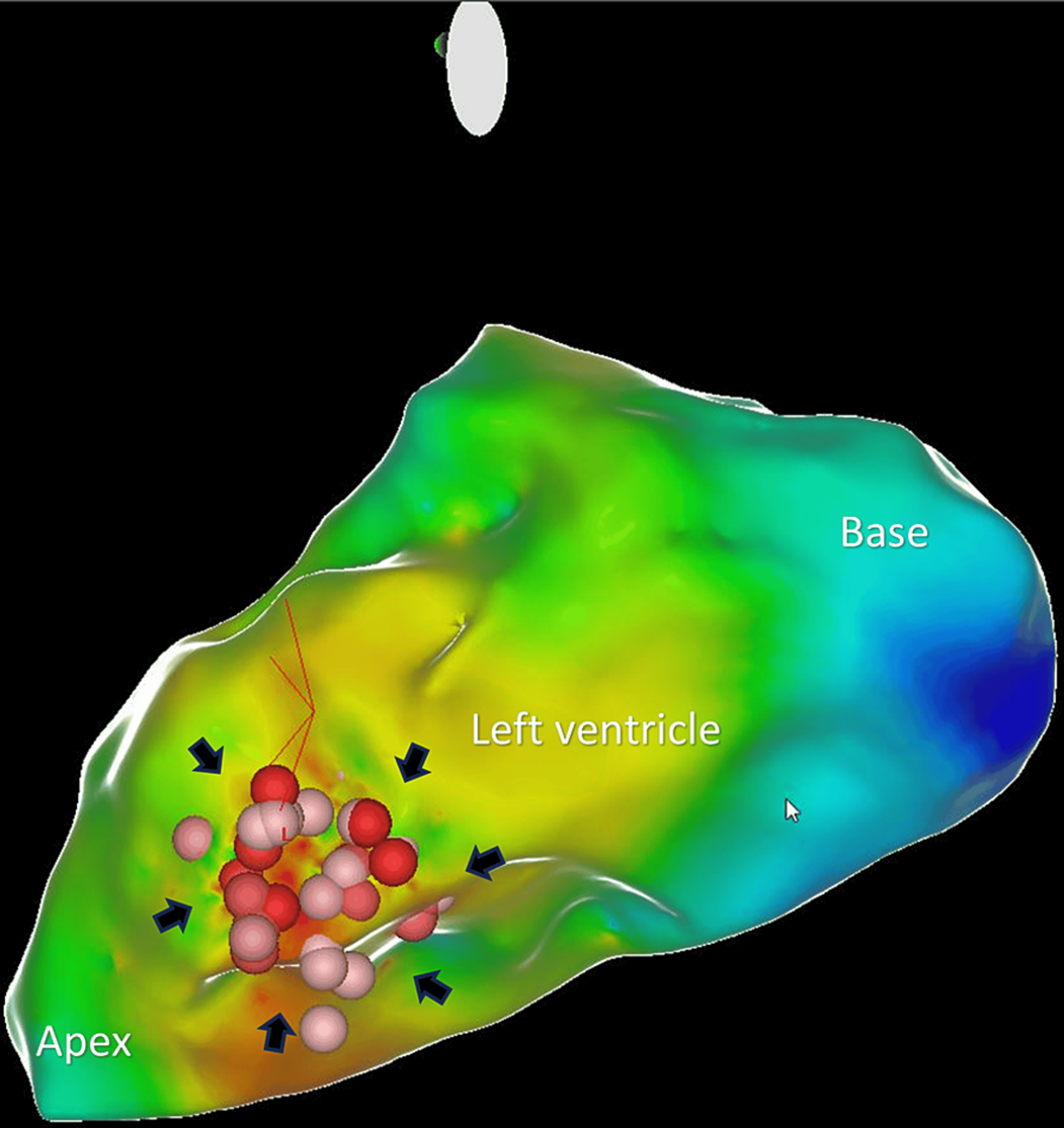 Idioventricular Rhythm: A Rare Presentation Of Left Ventricular 