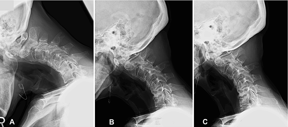 Lateral cervical spine showing C0-C3 fusion in reduced position after