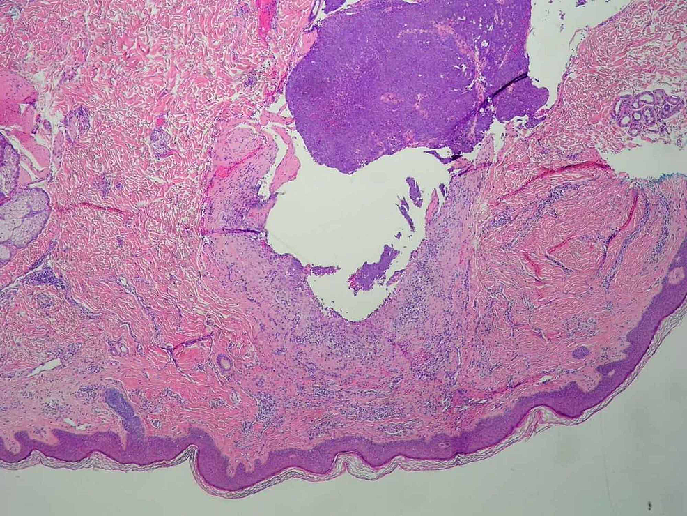 Malignant Hidradenocarcinoma of the Axilla | Cureus