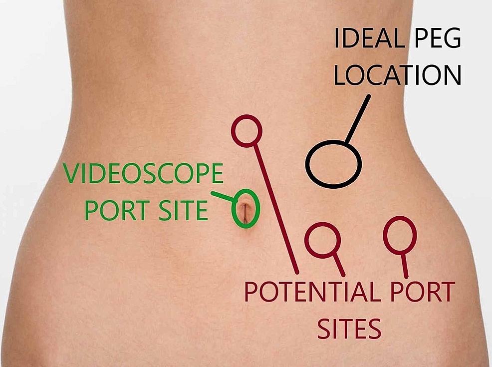 Cureus The Effectiveness of Laparoscopicassisted Percutaneous Endoscopic Gastrostomy in