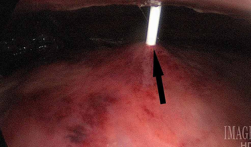 Cureus The Effectiveness of Laparoscopicassisted Percutaneous