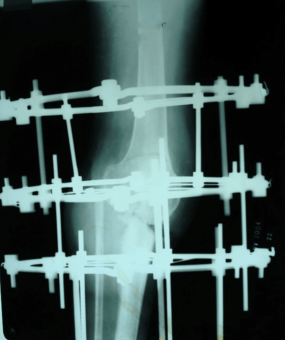 Limb Reconstruction Using The Ilizarov Technique Following Giant Cell ...