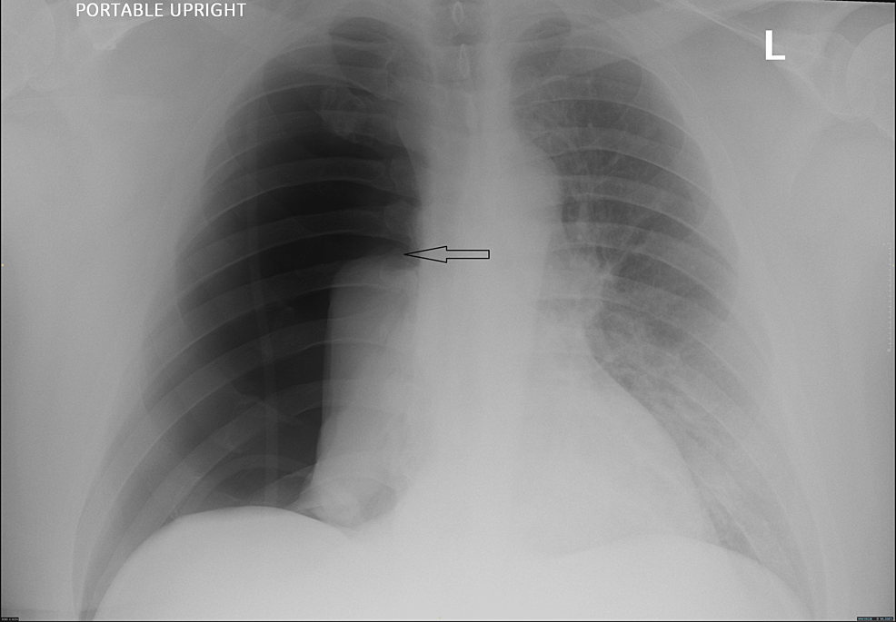 Delayed Pneumothorax Following Bougie-Assisted Nasal Intubation | Cureus