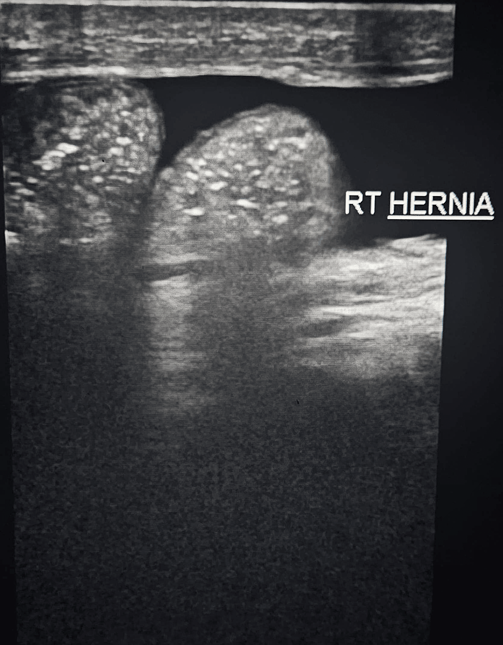 Amyands Hernia With Sliding Component A Case Report Cureus