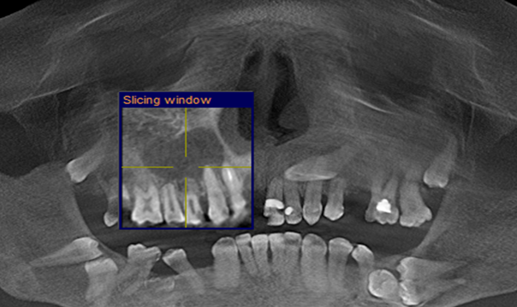 Cureus Aplasia Of The Maxillary Sinus A Large Periapical Cyst In The Maxillary Arch And A 2672