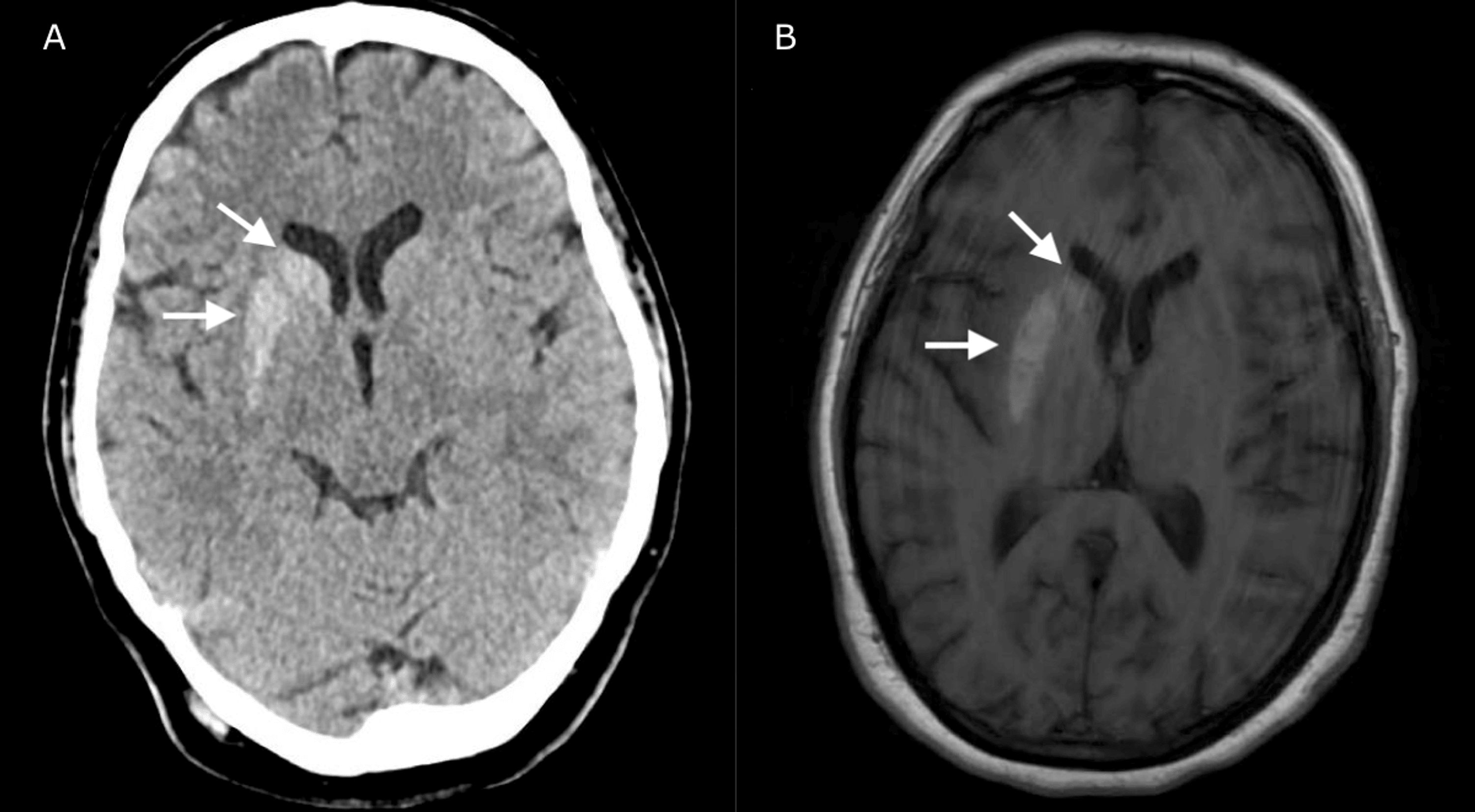 Cureus | A Case Report and Literature Review of Nonketotic ...