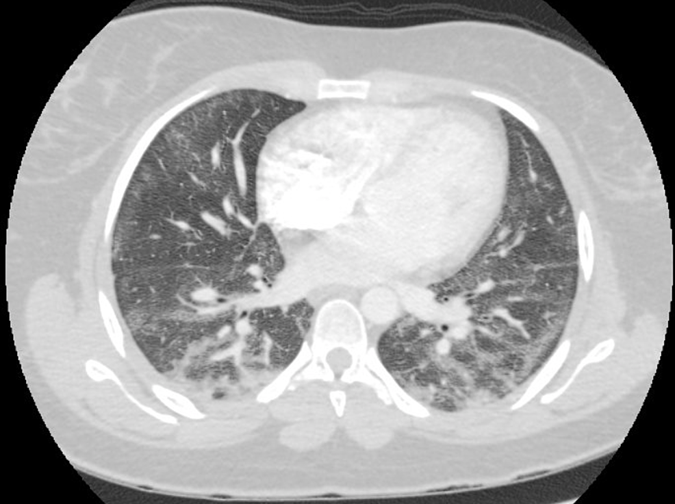 CTA-chest-showing-bilateral-ground-glass-opacities