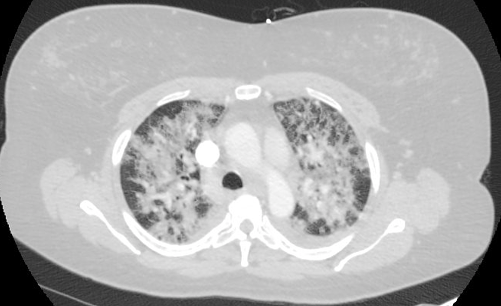 CTA-chest-showing-bilateral-alveolar-opacities