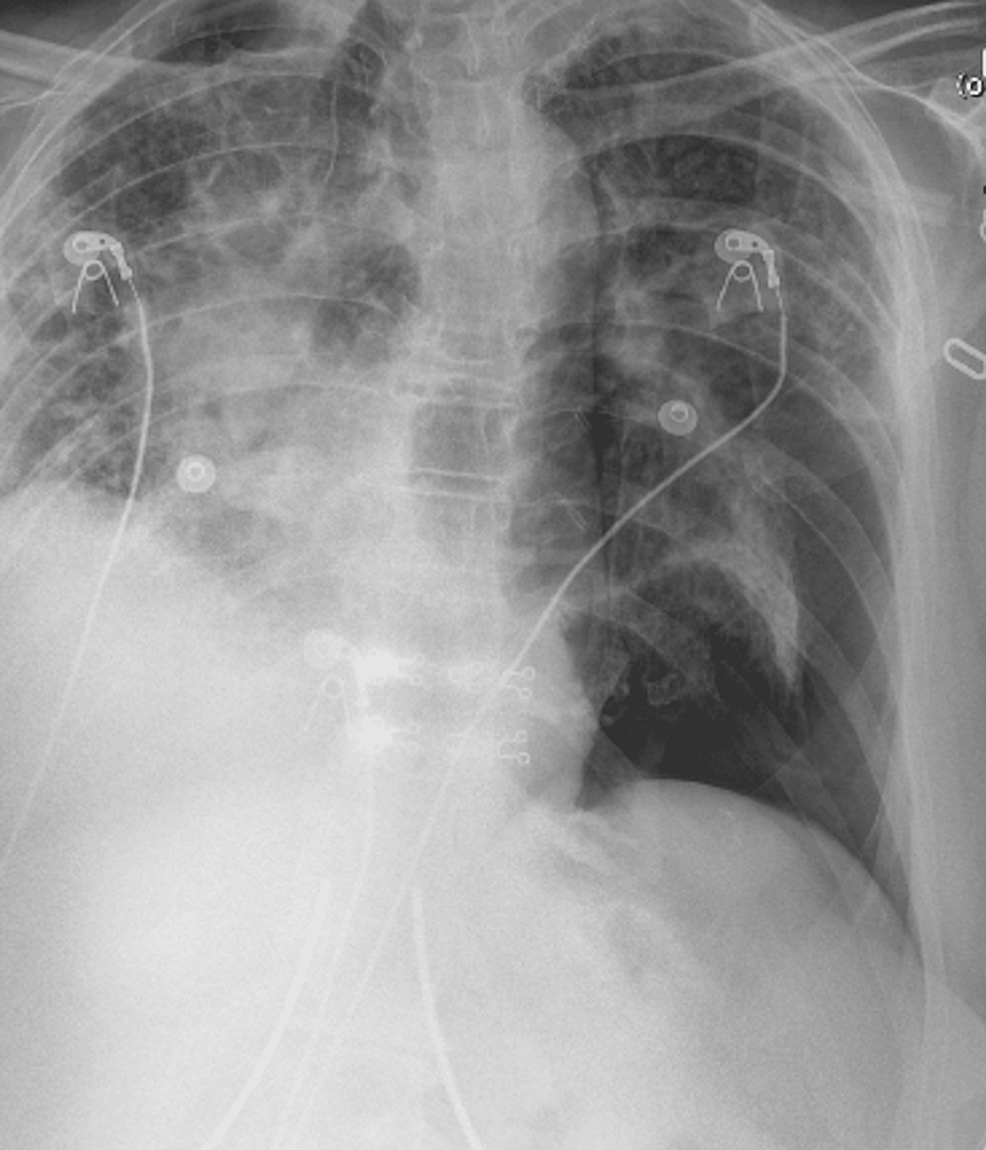 cureus-secondary-spontaneous-pneumothorax-in-a-patient-with